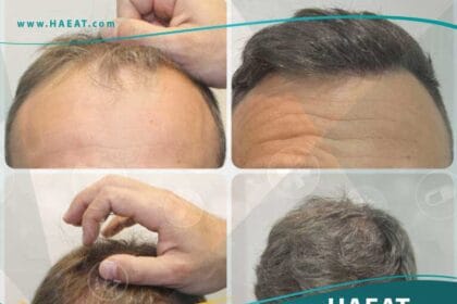 قبل وبعد زراعة الشعر