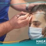تكلفة زراعة الشعر