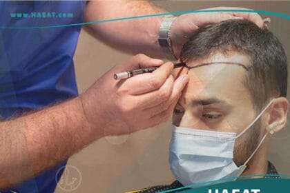 تكلفة زراعة الشعر