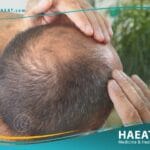 تكاليف عملية زراعة الشعر