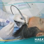 أفضل وأضمن طريقة لزراعة الشعر في العالم