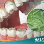 جير الأسنان