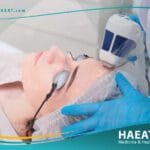 تجديد سطح الجلد بالليزر