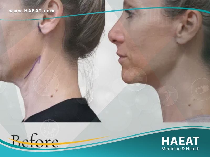 عملية شد الرقبة