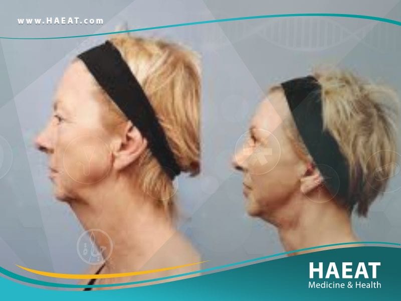 عملية شد الرقبة