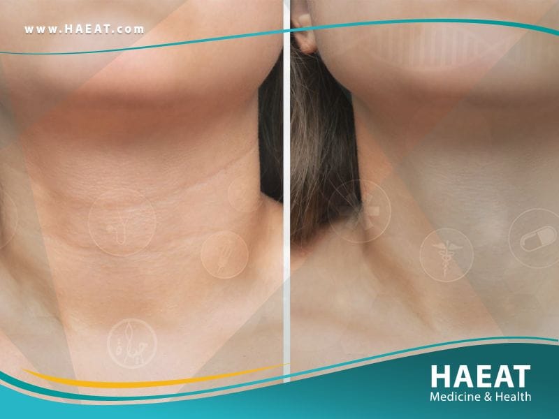 عملية شد الرقبة