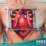 عملية القلب المفتوح