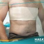 تصغير الثدي للرجال