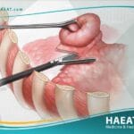 استئصال فقاعة هوائية من الرئة