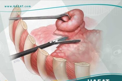 استئصال فقاعة هوائية من الرئة