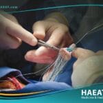 تغيير صمام القلب