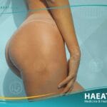 جراحة حقن الدهون بالمؤخرة