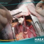 تغيير صمام القلب التاجي