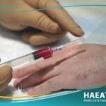 حقن البلازما لليدين