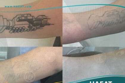 إزالة الوشم بالليزر