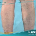 إزالة الاوردة عروق العنكبوت