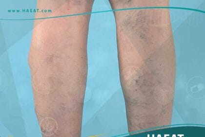 إزالة الاوردة عروق العنكبوت