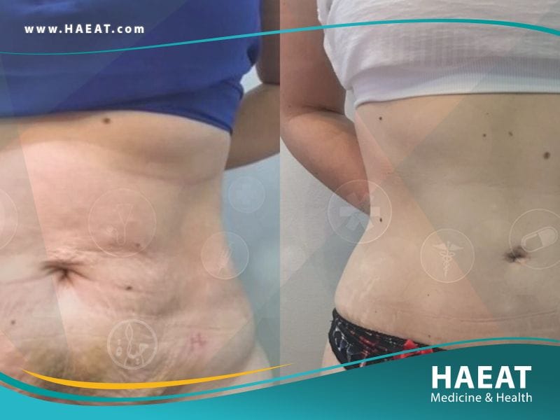 شد البطن بالليزر