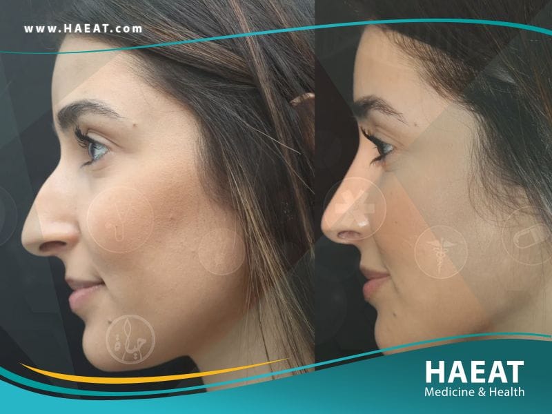 عملية تجميل الأنف | 7 نصائح قبل الجراحة 22 عملية تجميل الأنف