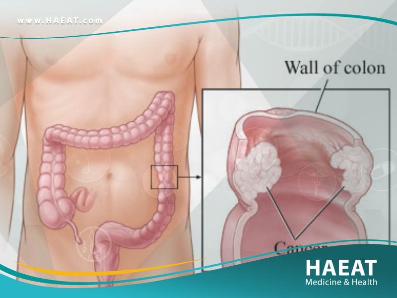 استئصال أمعاء جزئي | 3 أسباب لإجراء العملية 22 استئصال أمعاء جزئي