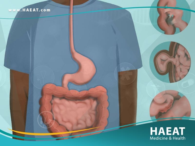 استئصال الأمعاء الجزئي