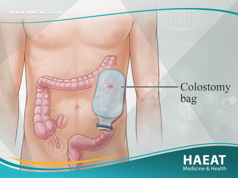 استئصال الأمعاء الجزئي