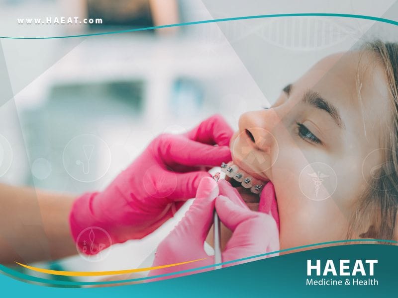 تقويم الاسنان