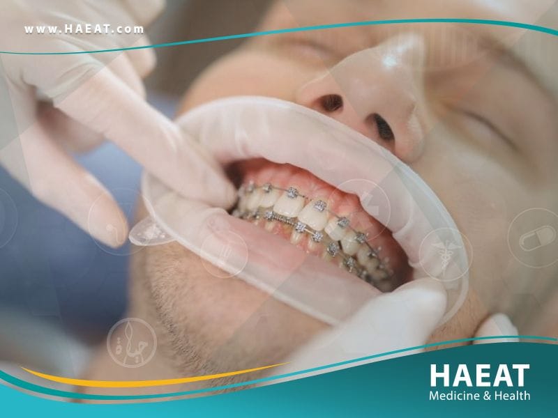 تقويم الاسنان