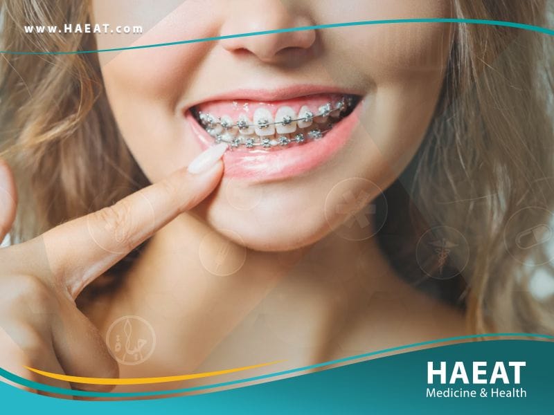 تقويم الاسنان