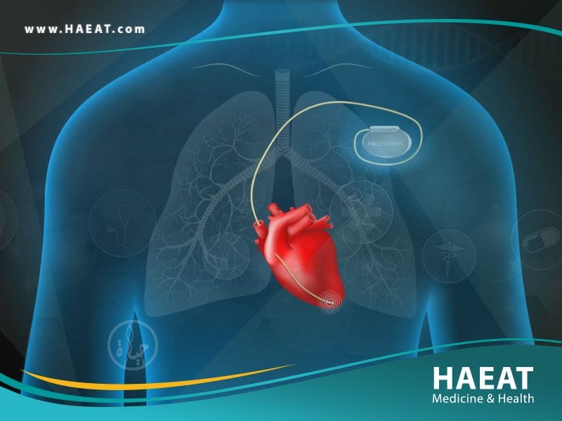 زرع جهاز تنظيم ضربات القلب