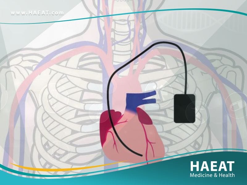 زرع جهاز تنظيم ضربات القلب