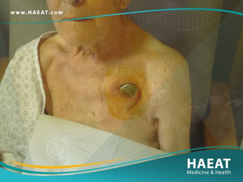 زرع جهاز تنظيم ضربات القلب