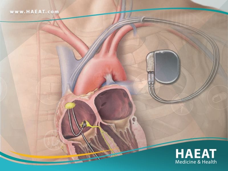 زرع جهاز تنظيم ضربات القلب