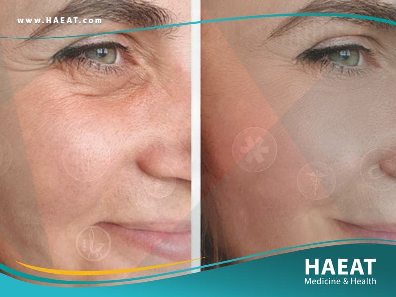 شد الوجه بدون جراحة