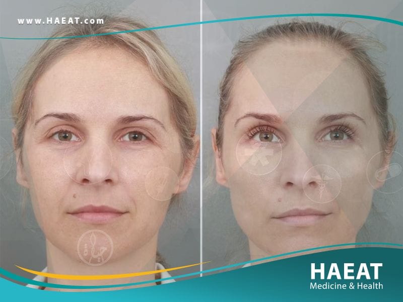 شد الوجه بدون جراحة