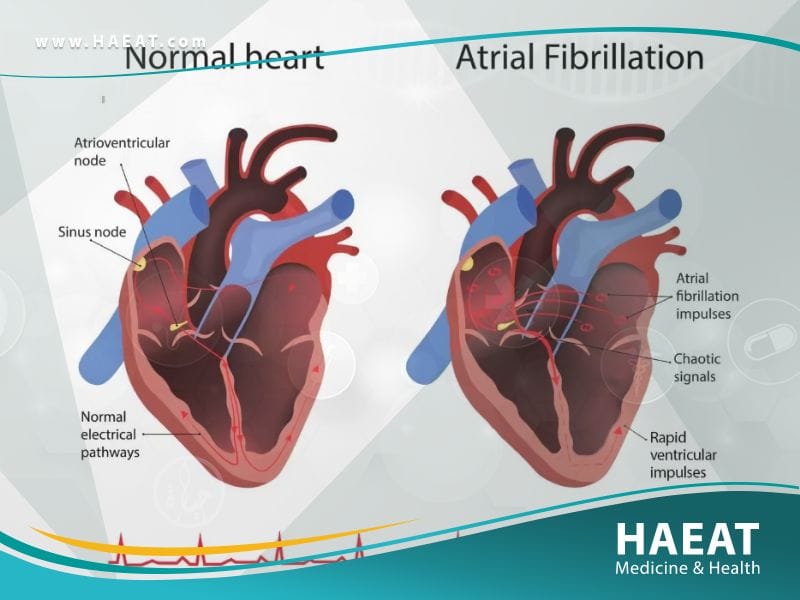 علاج الرجفان الأذيني