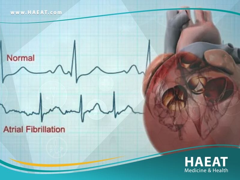 علاج الرجفان الأذيني