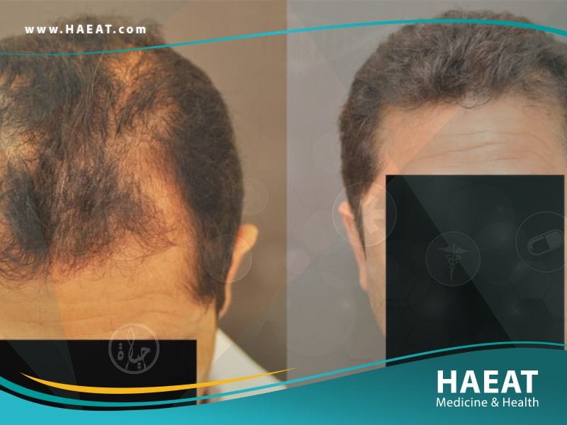 أحدث تقنيات زراعة الشعر