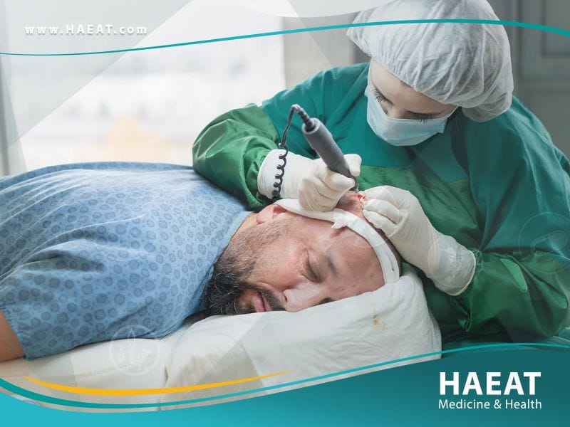 أحدث عمليات زراعة الشعر