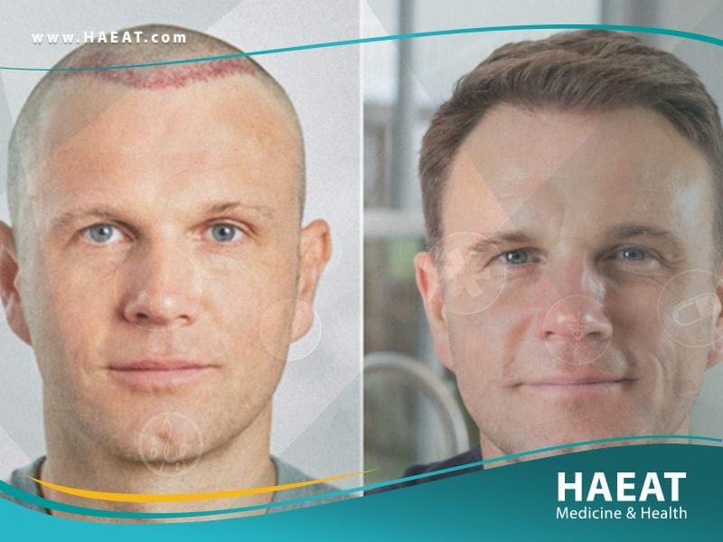 أحدث عمليات زراعة الشعر