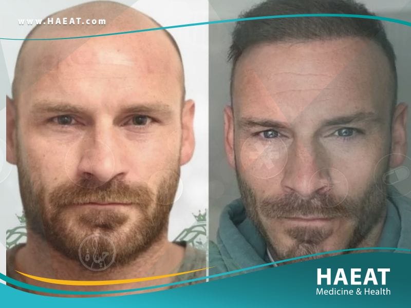 أحدث عمليات زراعة الشعر