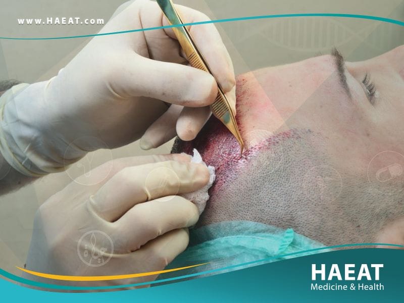 أحدث عمليات زراعة الشعر