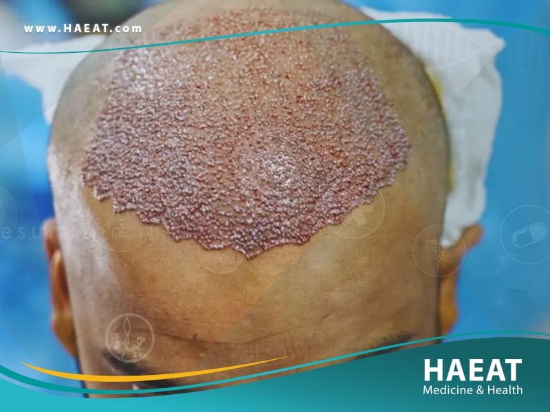 أحدث عمليات زراعة الشعر