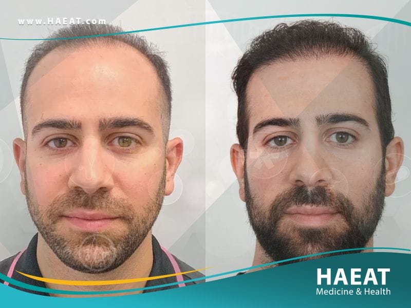 أفضل دكتور زراعة شعر في تركيا