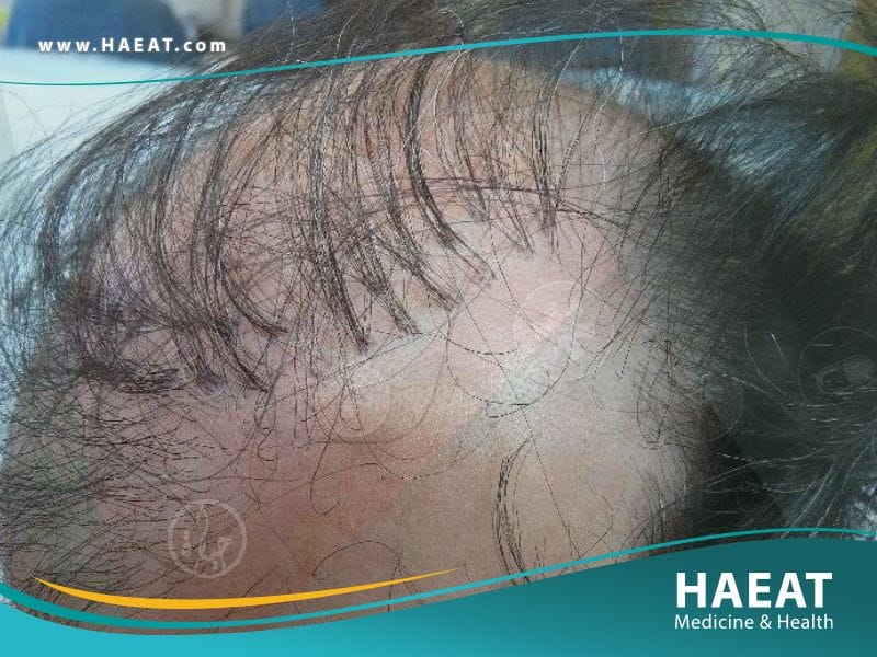 أفضل دكتور زراعة شعر في تركيا