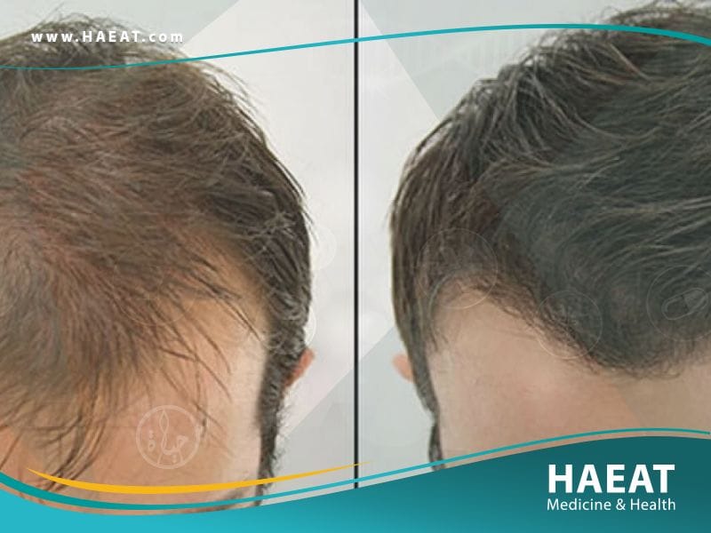 أفضل زراعة شعر في تركيا