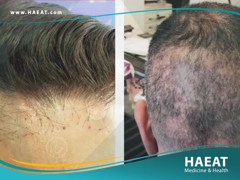 أفضل زراعة شعر في تركيا