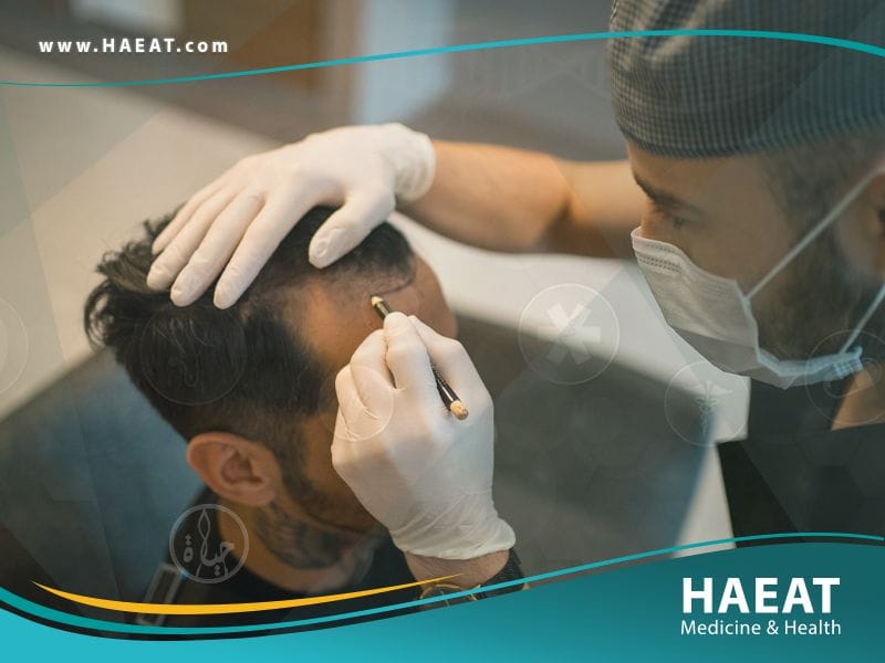 أفضل زراعة شعر في تركيا