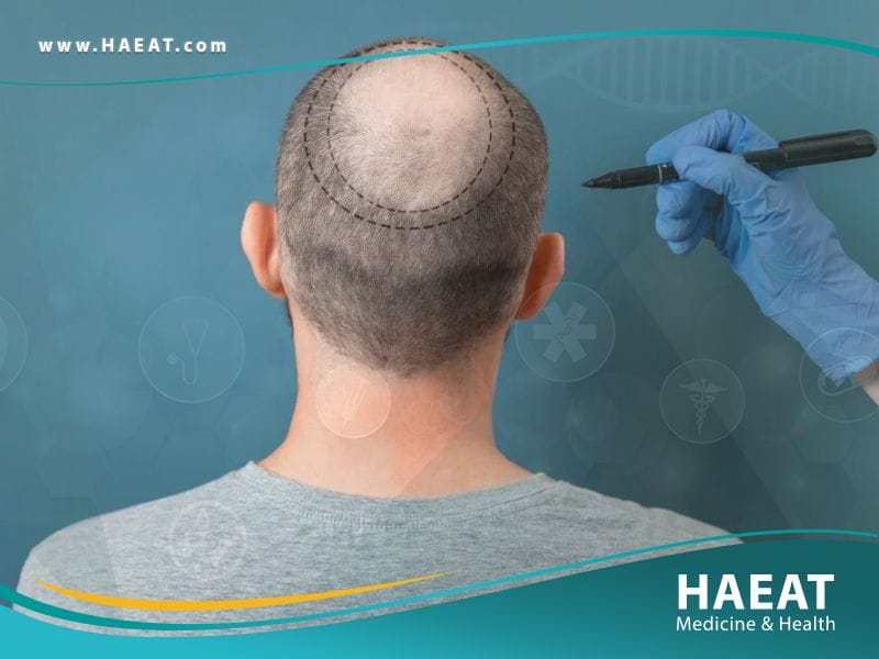 أفضل زراعة شعر في تركيا