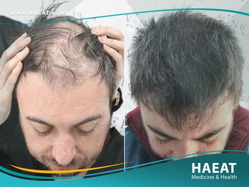 أفضل وأضمن طريقة لزراعة الشعر في العالم